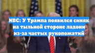 NBC: У Трампа появился синяк на тыльной стороне ладони из-за частых рукопожатий