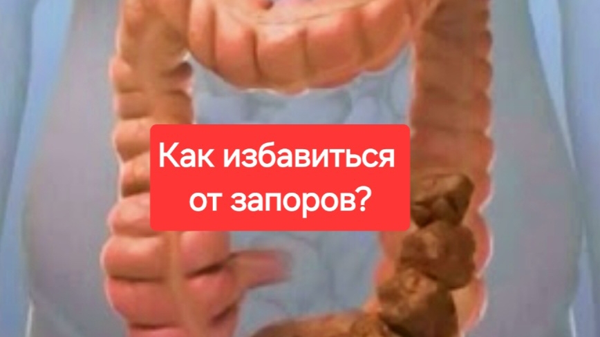 Запоры.Кау решить проблему с звпором.