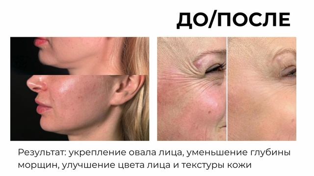 LP beauty studio (Микроигольчатый RF)