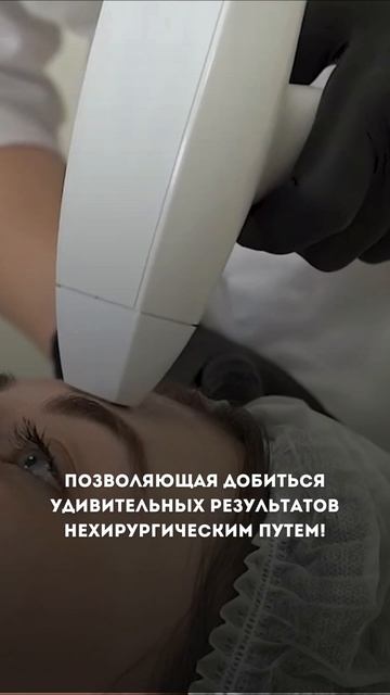 Микроигольчатый RF-лифтинг