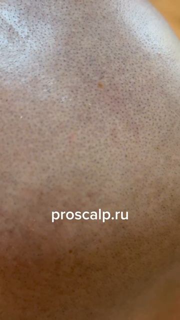 Трихопигментация через неделю #scalpmicropigmentation #татуволос #трихопигментация #smp