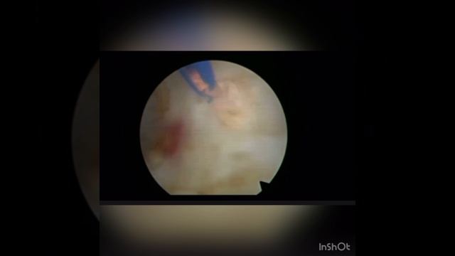 Лазерная цистолитотрипсия и лазерная энуклеация гиперплазии простаты