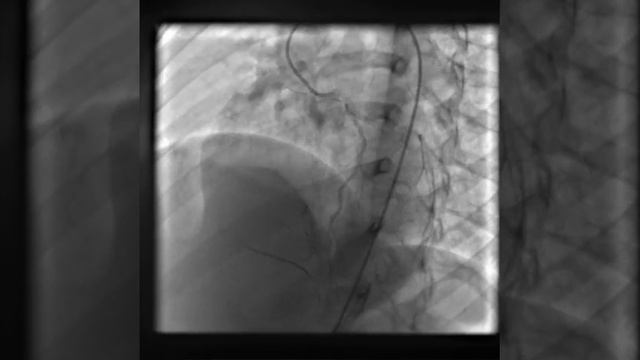 Kawasaki Disease - LCA injection with retrograde filling of RCA
