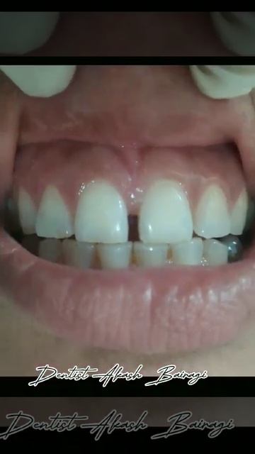 #Diastema clouser        #সামনের ফাকা দাঁতের চিকিৎসা