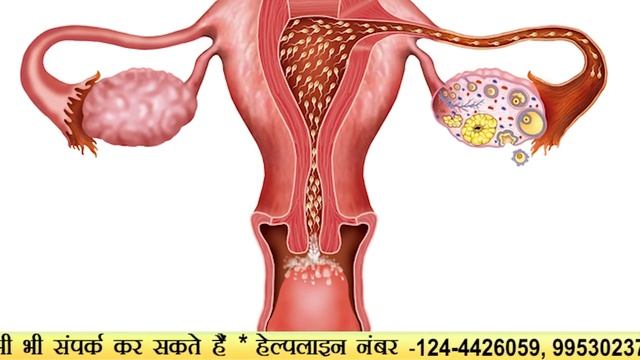 IVF से पहले कौन सा करना होता है टेस्ट ?   /  Couple test before IVF  ( HIndi )