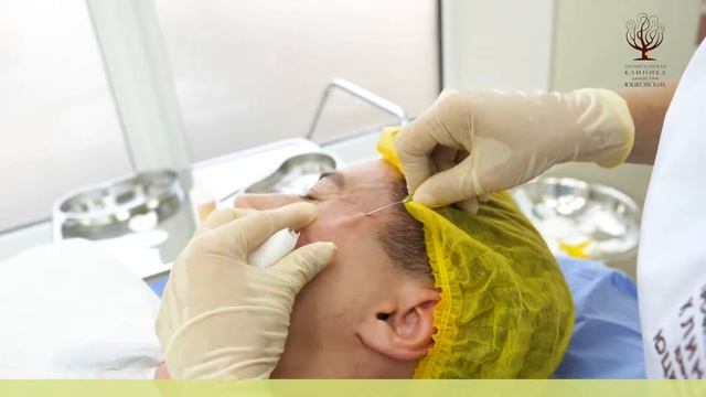 Коррекция рубцов постакне в Профессорской клинике Династии Юцковских