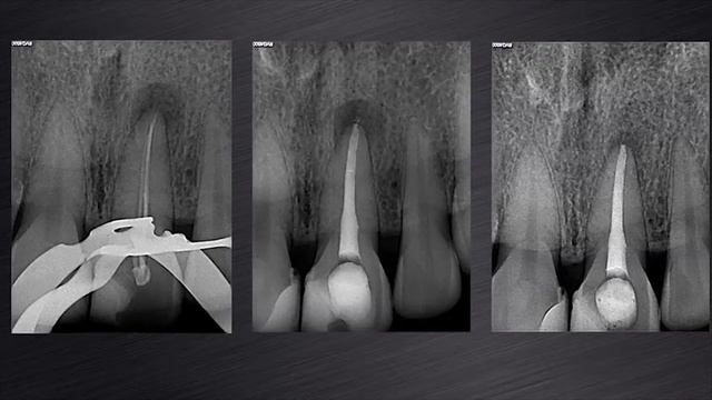 ProTaper Next® - Dealing with long roots with Dr. Peet van der Vyver | Dentsply Sirona