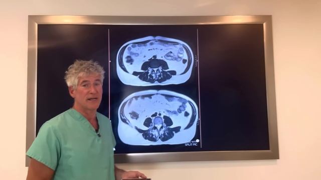 Недержание мочи, вызванное рассеянным склерозом, ИЗБАВИЛОСЬ от него после огромной потери висцеральн