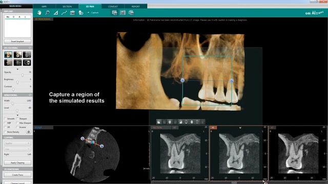 Endo Analysis Root Fracture | Ez3D-i | Vatech