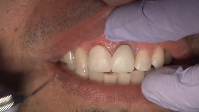 Case of the Week: Mask the Metal: An Obsidian® vs. BruxZir® Challenge