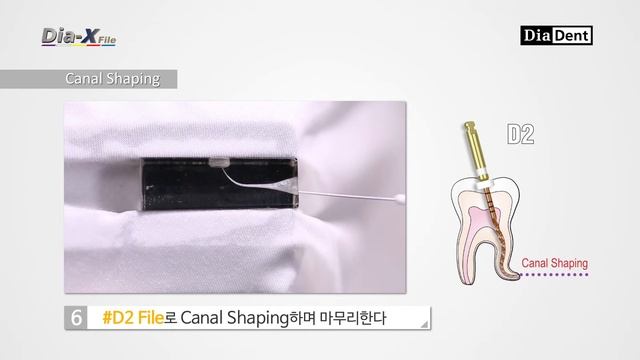 DiaDent Endodontic Treatment