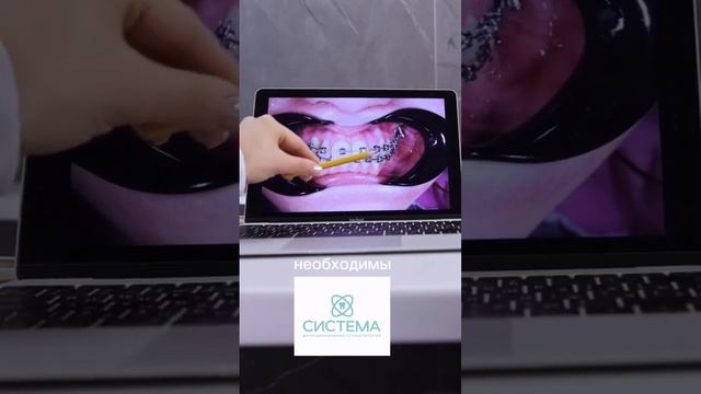 Повторное ортодонтическое лечение? Когда и почему нужно ставить брекеты.