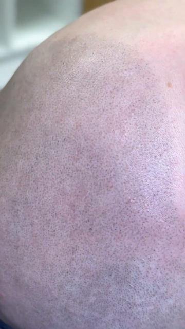 Scalp micropigmentation в Москве и СПб #микропигментация головы   #трихопигментация  #татуволос