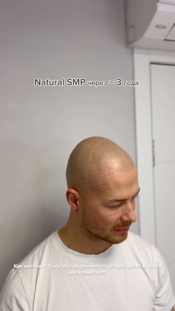 Как выглядит Scalp micropigmentation через несколько лет