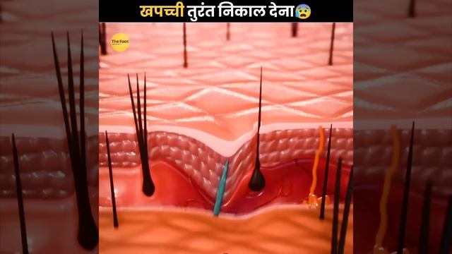 Splinter को तुरंत निकाल देना 😰 | Remove Splinter Immediately | The Fact | #shorts #ytshorts