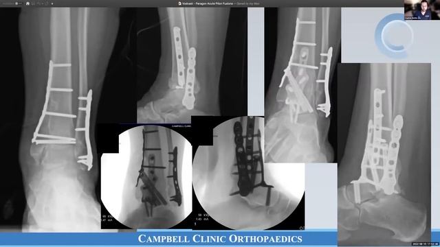 Hindfoot Fusion Strategies in Foot and Ankle