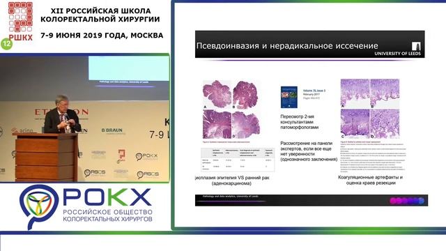 Philip Quirke Почему именно патолог главное звеном в определении прогноза больных ранним раком