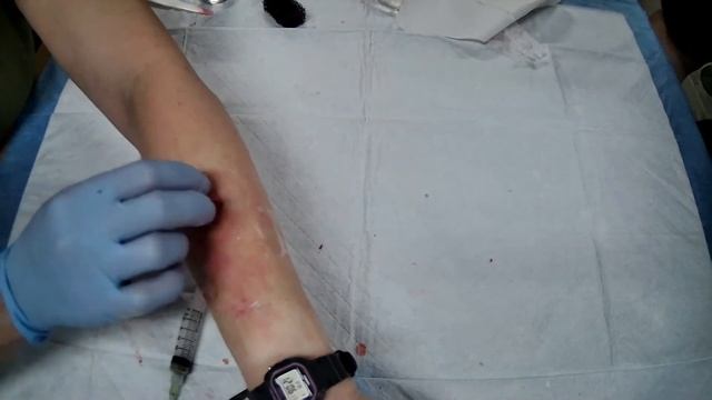 Trauma-  Burn: 2nd Degree with Peel off Mask