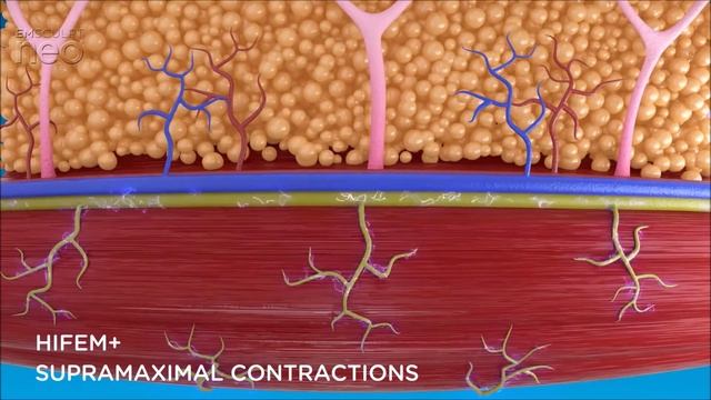 How Emsculpt Neo Works | VL Aesthetics