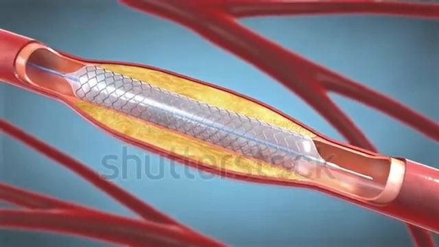 Stent Implantation Supporting Blood Circulation.Стентирование коронарных артерий