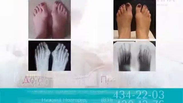 Хирургическое лечение стоп! Удаление "шишек" на стопах!