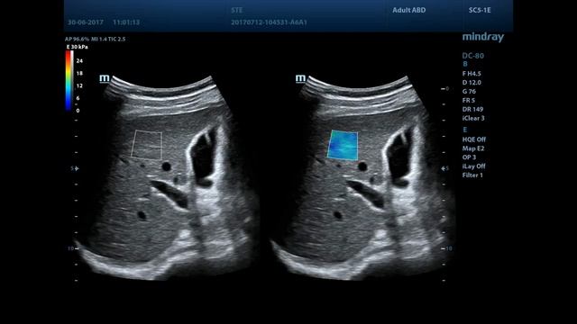 Sound Touch Elastography