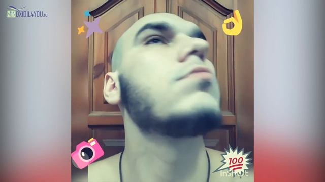 Миноксидил для бороды отзыв через полтора года применения миноксидила. Minoxidil4you