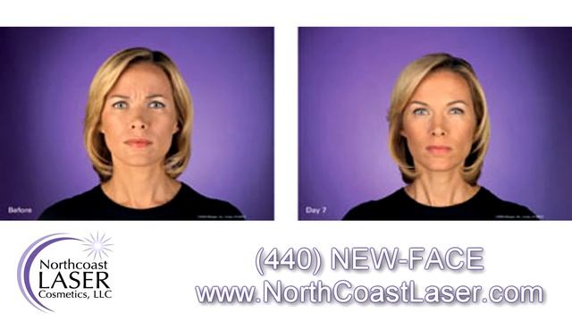 Botox Cleveland - North Coast Laser Cosmetics