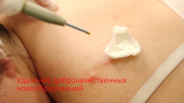 Удаление доброкачественных новообразований  в КБ «РЖД-Медицина» г. Пенза