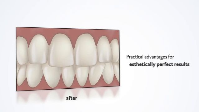 Veneer cementing with added value: the all-new Vitique system from DMG