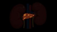 Protein Needs: Cirrhosis and Chronic Kidney Disease