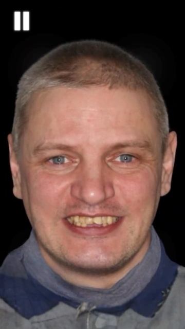 #всена4 Полное восстановление зубов в Санкт-Петербурге – быстро, надежно, навсегда!