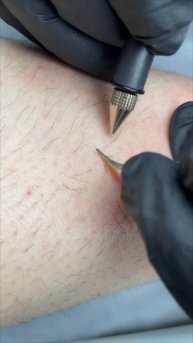 Электроэпиляция голени
