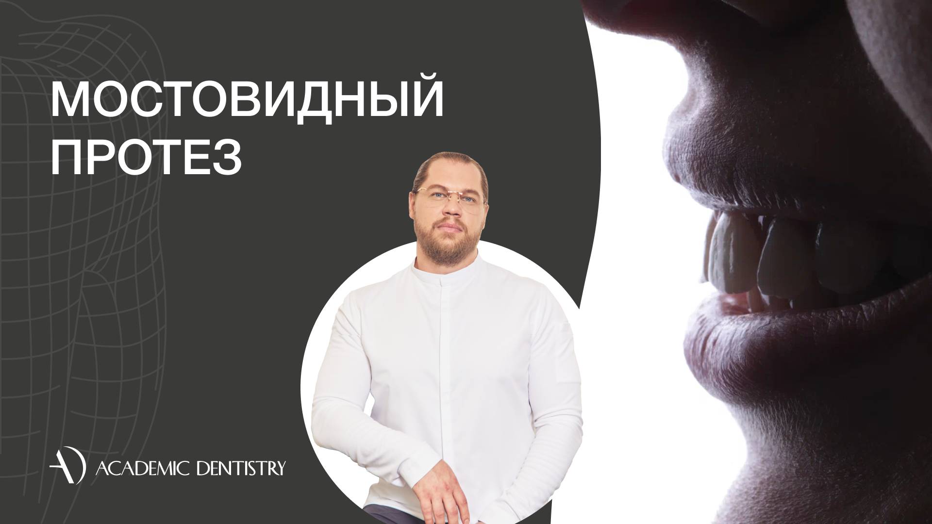 Мостовидные протезы: плюсы и минусы, цена, показания