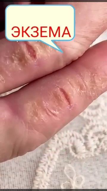 экзема результат после применения