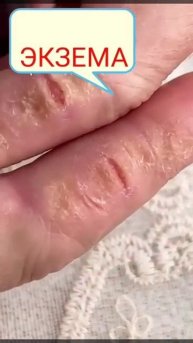 экзема результат после применения