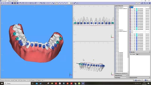 onyx braces