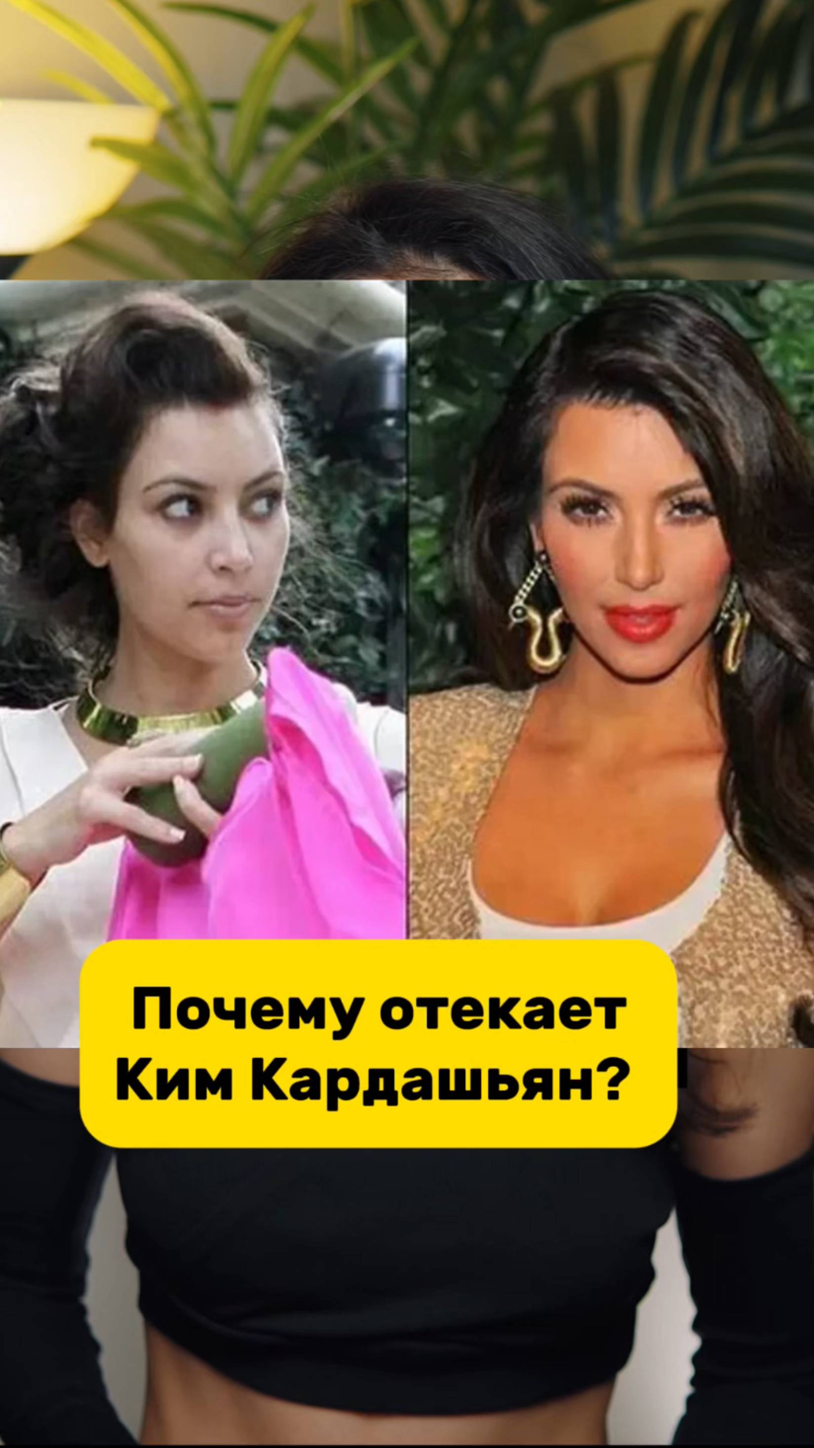 Почему Ким Кардашьян отекает?