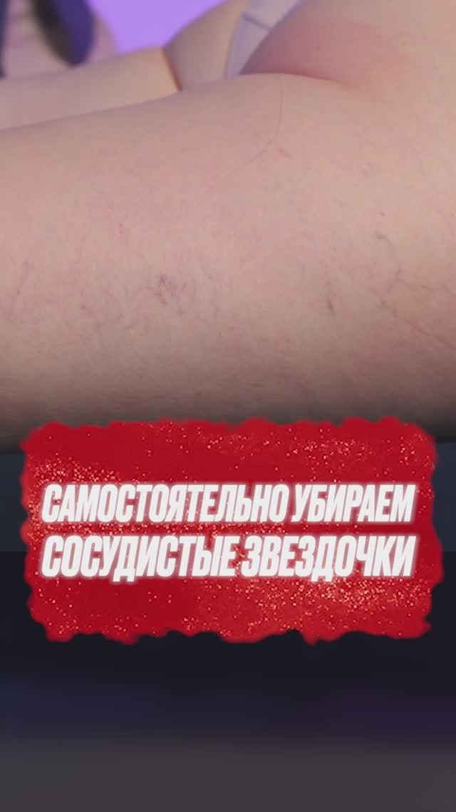 Как самостоятельно убрать сосудистые звездочки на ногах?