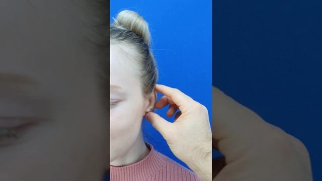 Отопластика - коррекция ушных раковин.