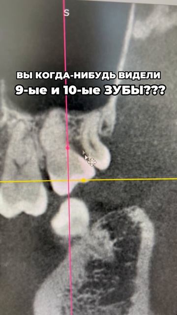Кому-то 9-е-10-е зубы дает, а у кого-то и стандартный набор неполный бывает