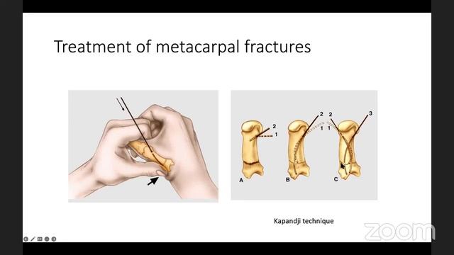 Hand fractures and wound by Prof  Pierre Mansat 12 3 2023