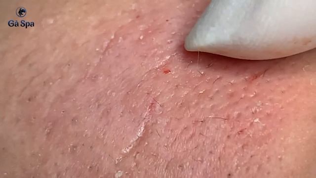 If You Like Squeezing Acnes, You'll Must be See This Video | Full 33 Minutes | GaSpa 18.03.2022