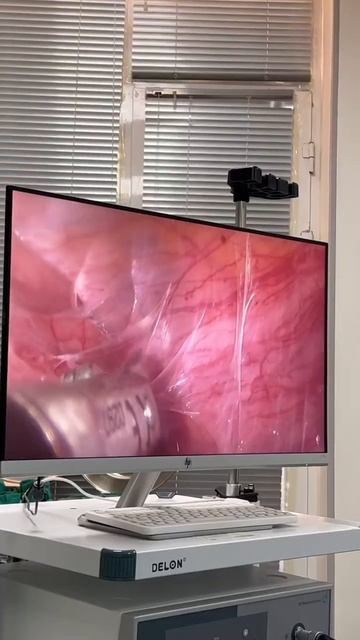 Лапароскопия + Гистероскопия