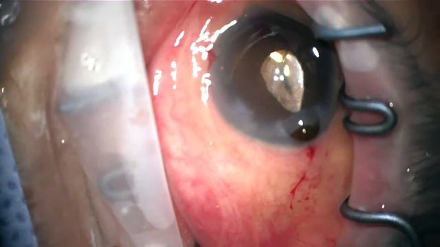 phacotrabectome severe allergic reaction to drops, inflammation, floppy iris, iris hooks #2