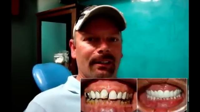 Cancun DENTIST VENEERS 😷 Dental Porcelain Veneers Procedure at Cancun Cosmetic Dentistry Mexico 😀