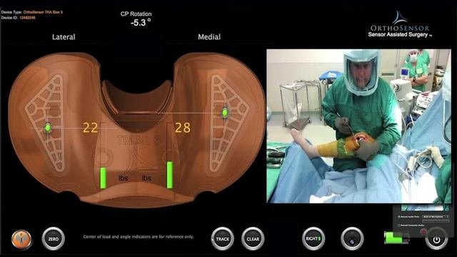 VERASENSE: Correcting Mid-Flexion Instability in a Varus Knee | Stryker Triathlon