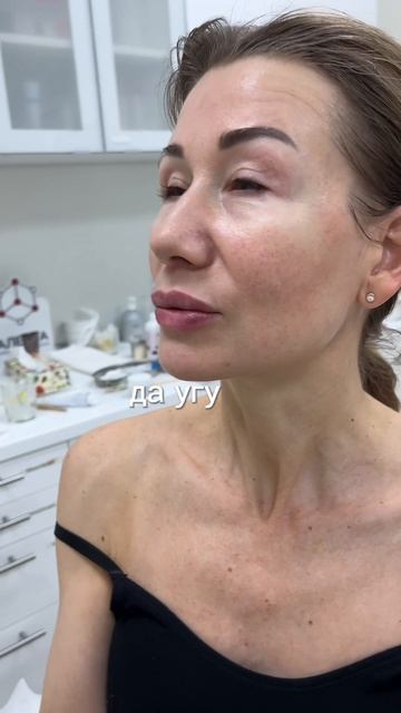 Увеличение губ впервые гиалуроновой кислотой у косметолога  #увеличение губ #уходзакожей #косметоло