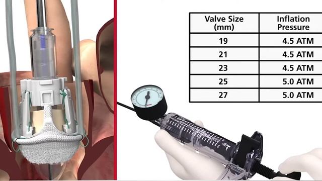 Intuity Valve Procedure for Aortic Stenosis