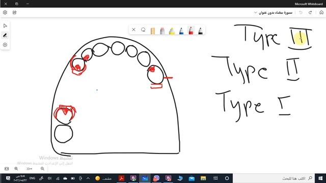 Step by step of RPD design Part4